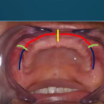 Alterazioni biomeccaniche susseguenti all’edentulismo dm_il-dentista-moderno_alterazioni-biomeccaniche-susseguenti-alledentulismo