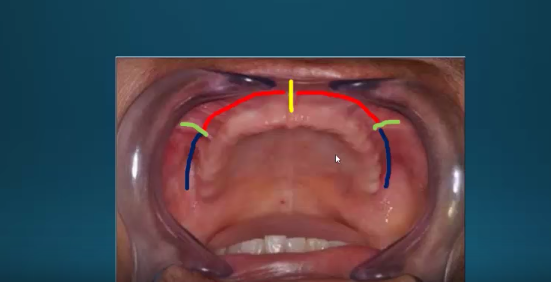 dm_il-dentista-moderno_alterazioni-biomeccaniche-susseguenti-alledentulismo