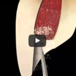 Anatomia canalare: incisivo centrale,laterale e canino mascellare dm_il-dentista-moderno_anatomia-canalare-incisivo-centrale-laterale-e-canino-mascellaridm_il-dentista-moderno_anatomia-canalare-incisivo-centrale-laterale-e-canino-mascellari