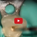 Anatomia endodontica: incisivi e canini inferiori dm_il-dentista-moderno_anatomia-endodontica-incisivi-e-canini-inferiori