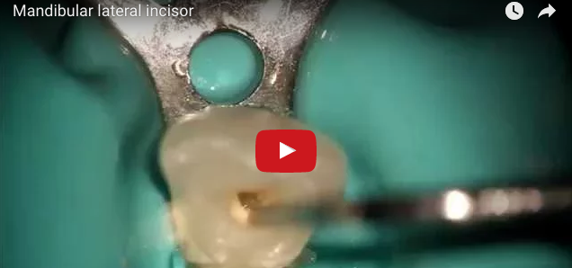 dm_il-dentista-moderno_anatomia-endodontica-incisivi-e-canini-inferiori