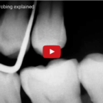 I parametri parodontali fondamentali: PPD, CAL e DGM dm_il-dentista-moderno_parametri-parodontali-ppd-cal-dmg