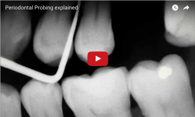 dm_il-dentista-moderno_parametri-parodontali-ppd-cal-dmg