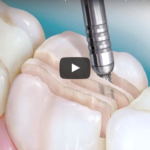 Protesi fissa su elementi naturali: concetti chiave della Reverse Preparation Technique: concetti chiave della Reverse Preparation Technique dm_il-dentista-moderno_protesi-fissa-su-elementi-naturali_reverse-preparation-technique