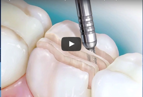 dm_il-dentista-moderno_protesi-fissa-su-elementi-naturali_reverse-preparation-technique