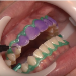 Sbiancamento dentale: gli effetti psico-sociali e sulla qualità di vita dm_il-dentista-moderno_sbiancamento-dentale-agenti-sbiancanti