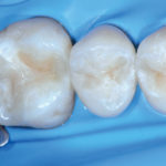 Tecnica semplificata di ricostruzione dentaria: la «modellazione fluida»