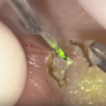 ABC per l’identificazione delle lesioni sottomucose dm_il-dentista-moderno_lesioni-sottomucose_laser