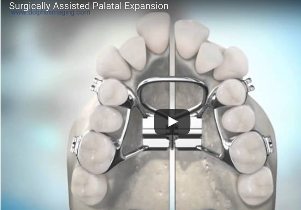 dm_il-dentista-moderno_-tecnica-chirurgica-per-espansione-del-palato-nel-subadulto