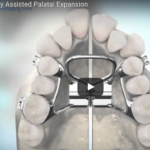 Tecnica chirurgica per espansione del palato nel subadulto dm_il-dentista-moderno_-tecnica-chirurgica-per-espansione-del-palato-nel-subadulto