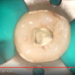 Anatomia canalare: molari inferiori dm_il-dentista-moderno_anatomia-canalare-molari-inferiori