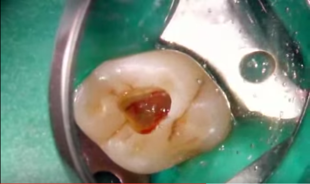 dm_il-dentista-moderno_anatomia-canalare_molari-superiori