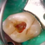 Anatomia canalare: molari superiori dm_il-dentista-moderno_anatomia-canalare_molari-superiori