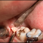 Coronectomia: alternativa all’estrazione dei denti denti del giudizio inferiori dm_il-dentista-moderno_corticotomio-terzi-molari-inferiori