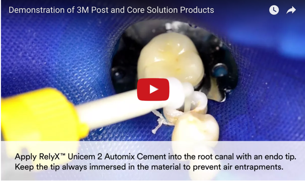 DM_il dentista moderno_cementazione perno in fibra_adesivo universale_adesivo multimode