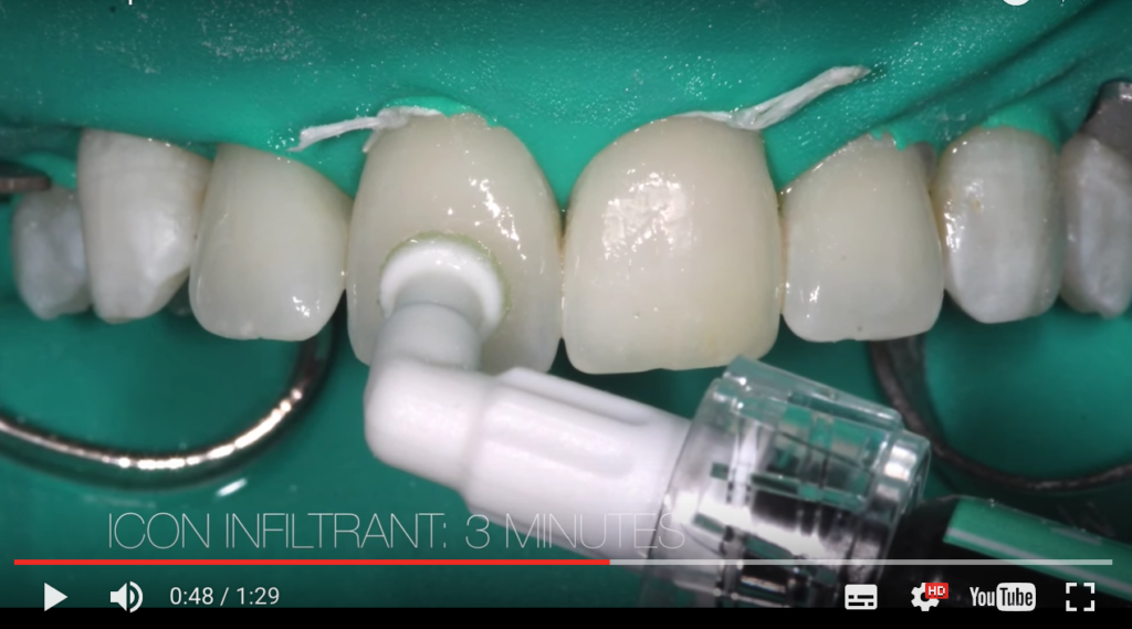 DM_il dentista moderno_ Amelogenesi imperfetta e difetti nella formazione di smalto e dentina