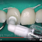 Amelogenesi imperfetta e difetti nella formazione di smalto e dentina DM_il dentista moderno_ Amelogenesi imperfetta e difetti nella formazione di smalto e dentina