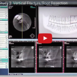 Scoperte incidentali alla CBCT e gestione clinica DM_il dentista moderno_CBCT_fratture radicolari