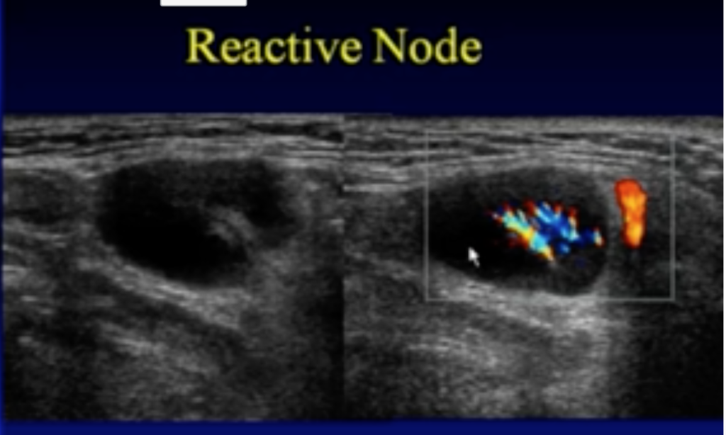 DM_il dentista moderno_esami non radianti in odontoiatria_Ecografia delle ghiandole salivari maggiori