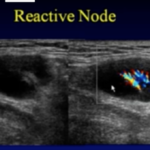 Ecografia delle ghiandole salivari maggiori DM_il dentista moderno_esami non radianti in odontoiatria_Ecografia delle ghiandole salivari maggiori