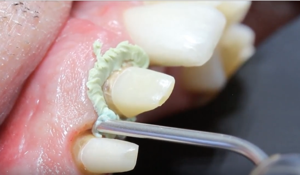 DM_il dentista moderno_retrazione gengivale in protesi fissa 2