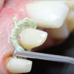 Sistematiche atraumatiche nella retrazione del margine gengivale DM_il dentista moderno_retrazione gengivale in protesi fissa 2