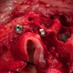 Tecnica riabilitativa implantoprotesica All-on-4® di Enrico Agliardi Agliardi_Riabilitazione di casi complessi grazie all'ausilio di impianti inclinati, intraorali e zigomatici