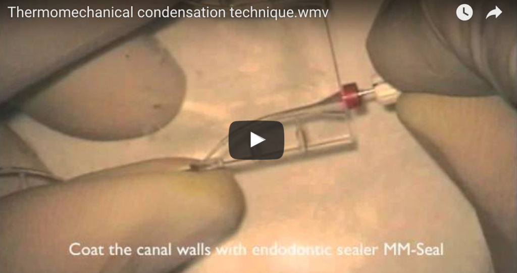 DM_il dentista moderno_ Guttaperca termoplasticizzata e condensazione termomeccanica
