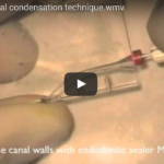 Guttaperca termoplasticizzata e condensazione termomeccanica DM_il dentista moderno_ Guttaperca termoplasticizzata e condensazione termomeccanica