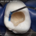 Il fenomeno dello stress da contrazione nelle resine composite DM_il dentista moderno_Il fenomeno dello stress da contrazione nelle resine composite