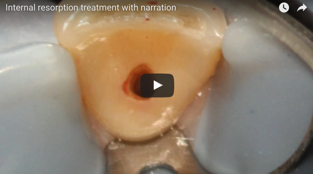DM_il dentista moderno_Riassorbimento radicolare interno