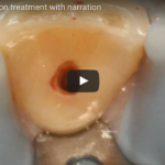 Riassorbimento radicolare interno: eziopatogenesi e terapia DM_il dentista moderno_Riassorbimento radicolare interno