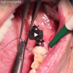 Tecniche di riapertura implantare DM_il dentista moderno_Tecniche di riapertura implantare