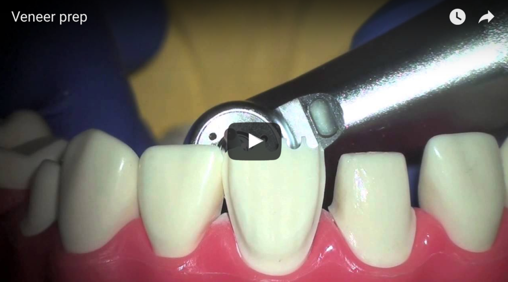 DM_il dentista moderno_faccette in ceramica