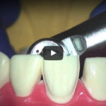 Faccette in ceramica: aspetti storici e tecnici DM_il dentista moderno_faccette in ceramica