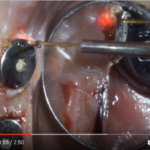 Laser e implantologia: prospettive DM_il dentista moderno_laser_parodontologia_implantologia