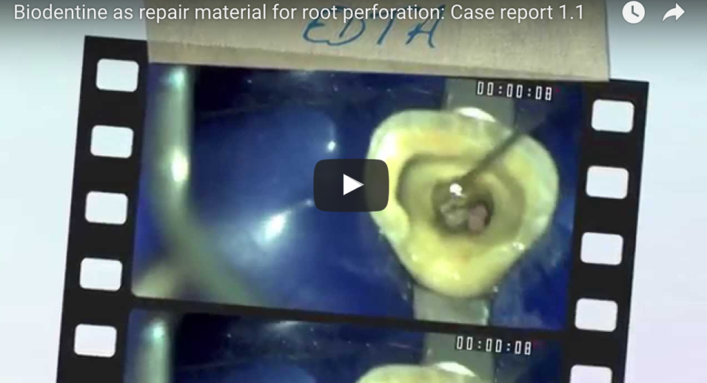 DM_IL DENTISTA MODERNO_ Materiali per il trattamento delle perforazioni endodontiche
