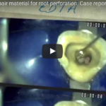 Materiali per il trattamento delle perforazioni endodontiche DM_IL DENTISTA MODERNO_ Materiali per il trattamento delle perforazioni endodontiche