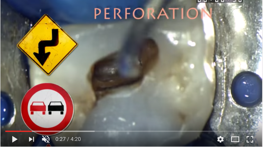 DM_il dentista moderno_Trattamento delle perforazioni endodontiche