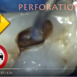 Trattamento delle perforazioni endodontiche DM_il dentista moderno_Trattamento delle perforazioni endodontiche