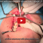 Espansione rapida del palato chirurgicamente assistita e sue complicanze DM_il dentista moderno_espansione del palato