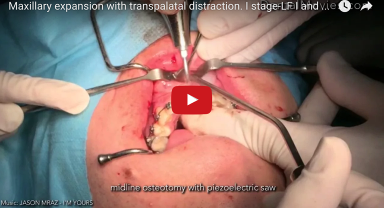 Espansione rapida del palato chirurgicamente assistita e sue complicanze