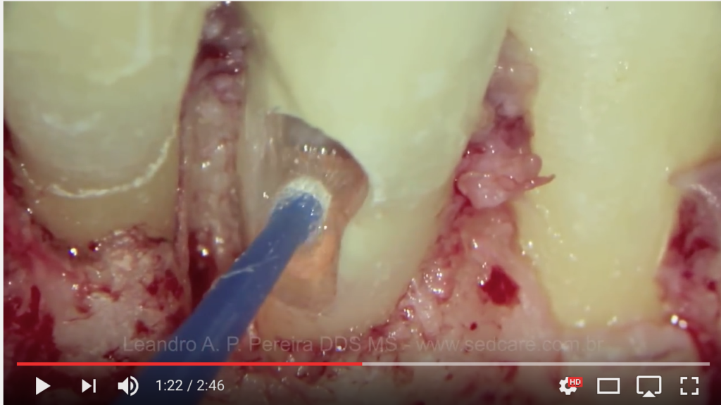 DM_il dentista moderno_perforazioni endodontiche classificazione