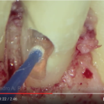 Classificazione delle perforazioni endodontiche DM_il dentista moderno_perforazioni endodontiche classificazione