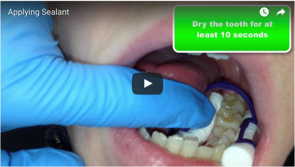 DM_IL DENTISTA MODERNO_ aggiorna le proprie linee guida pediatriche sulla sigillatura