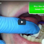 L’ADA aggiorna le proprie linee guida pediatriche sulla sigillatura DM_IL DENTISTA MODERNO_ aggiorna le proprie linee guida pediatriche sulla sigillatura