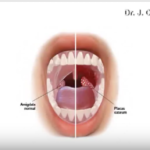 Alitosi: condizioni predisponenti e tipologie DM_il dentista moderno_ Alitosi condizioni predisponenti e tipologieDM_il dentista moderno_ Alitosi condizioni predisponenti e tipologie