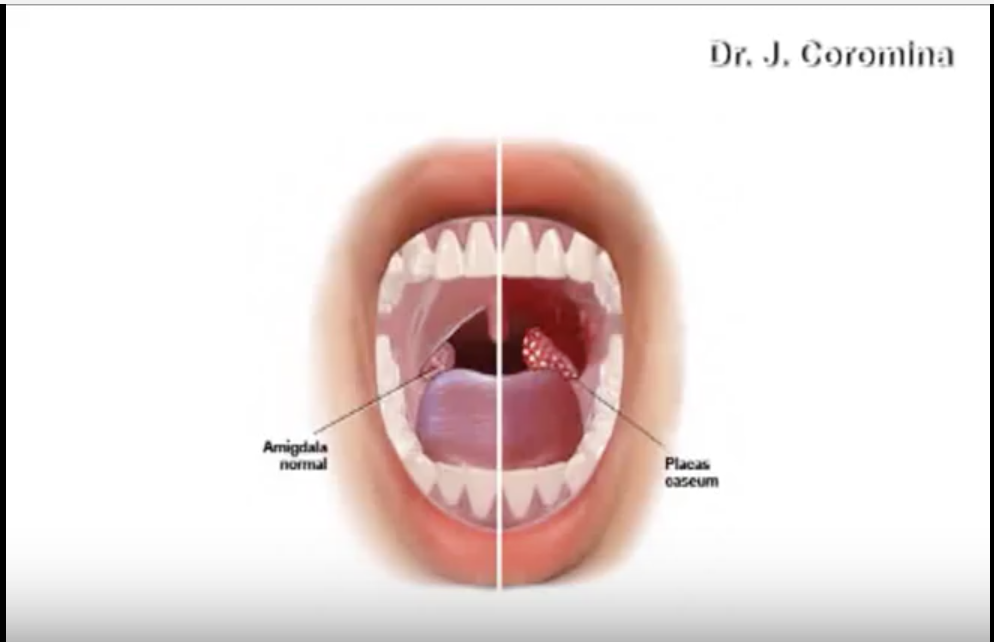 DM_il dentista moderno_ Alitosi condizioni predisponenti e tipologieDM_il dentista moderno_ Alitosi condizioni predisponenti e tipologie