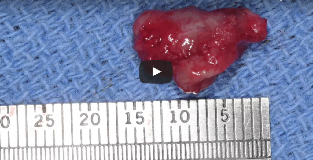 DM_il dentista moderno_Decorso postoperatorio di grosse lesioni cistiche dei mascellari