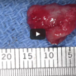 Decorso postoperatorio di grosse lesioni cistiche dei mascellari: approccio evidence based DM_il dentista moderno_Decorso postoperatorio di grosse lesioni cistiche dei mascellari